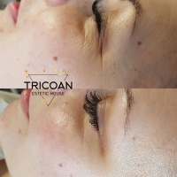 TricoAn